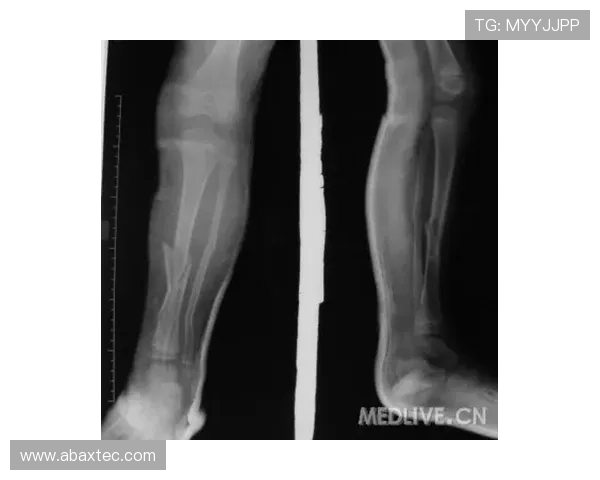 李镇全左腓骨骨折预计3个月康复